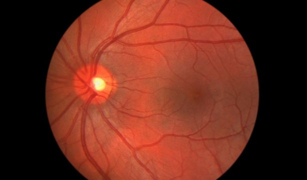 Nuevo avance en la curación de la pérdida de visión por diabetes