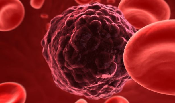 ¿Qué es la hipertemia? Mejora hasta en un 20% la respuesta al tratamiento contra el cáncer(Bigstock)