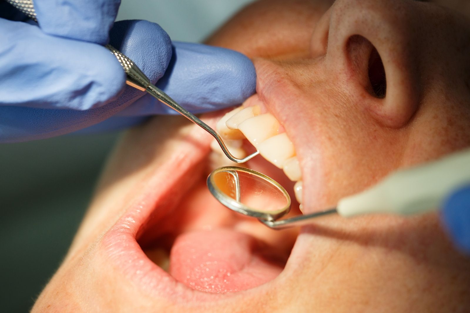 Las caries en personas mayores no se tratan en la mayoría de los casos, alertan los dentistas
