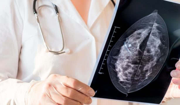 Un estudio basado en IA ofrece una visión más completa del cáncer de mama metastásico