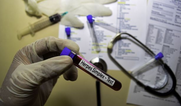 El virus del herpes podría duplicar el riesgo de desarrollar demencia