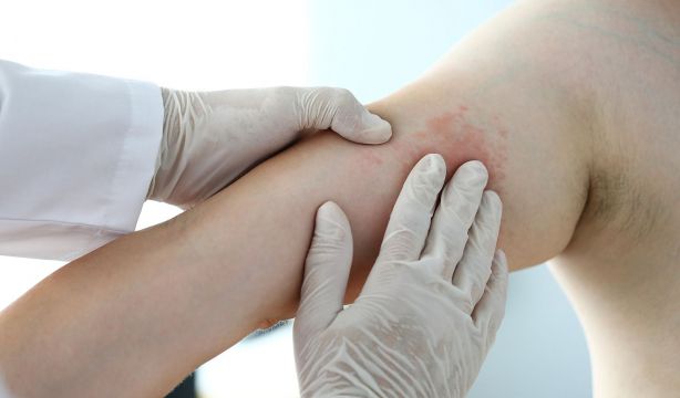 ¿Sabes de dónde viene el término urticaria? Diccionario anecdótico de términos médicos: 'U'