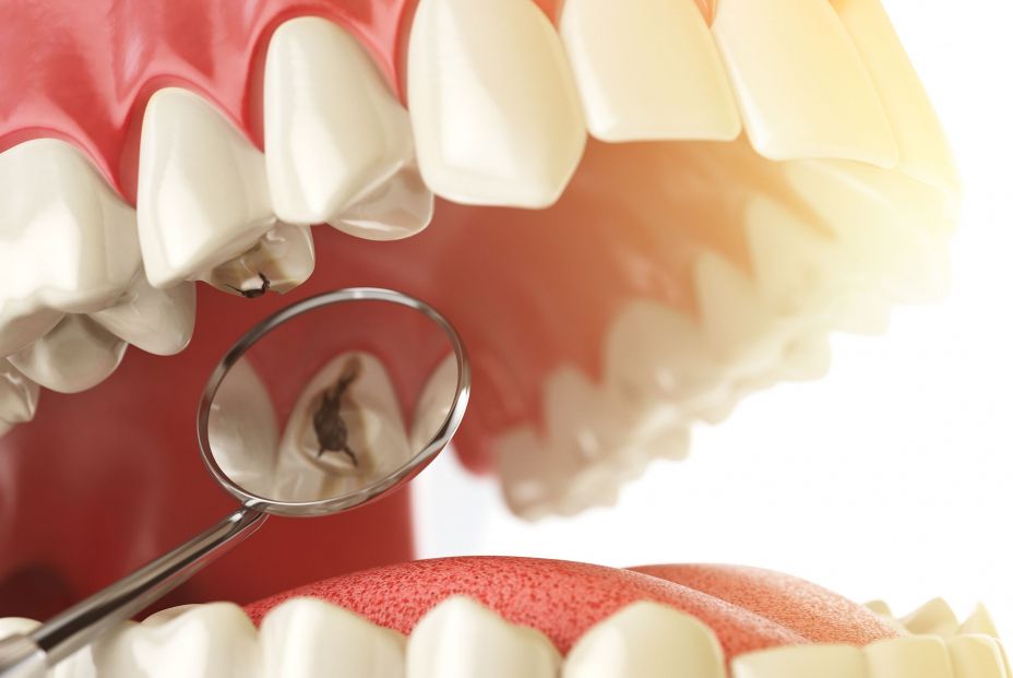 Los hallazgos en dientes de la Edad de Bronce revelan el impacto de la dieta en la salud dental (Bigstock) Los hallazgos en dientes de la Edad de Bronce revelan el impacto de la dieta en la salud dental (Bigstock)