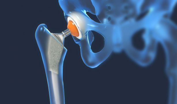 La Fiscalía pide indemnizar a pacientes afectados por prótesis de cadera defectuosas