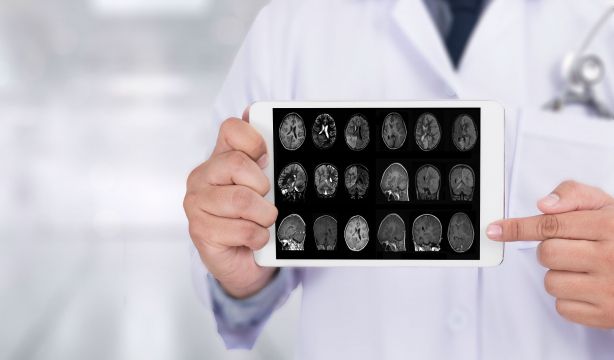 Avances en el alzheimer: esta es la parte del cerebro cuya degeneración empeora la enfermedad