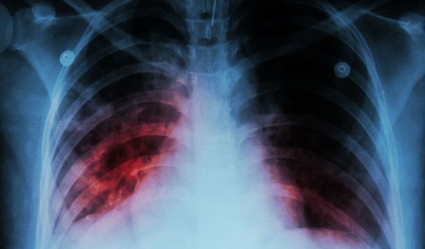 Las personas con tuberculosis tienen un 80%  más de probabilidades de padecer cáncer