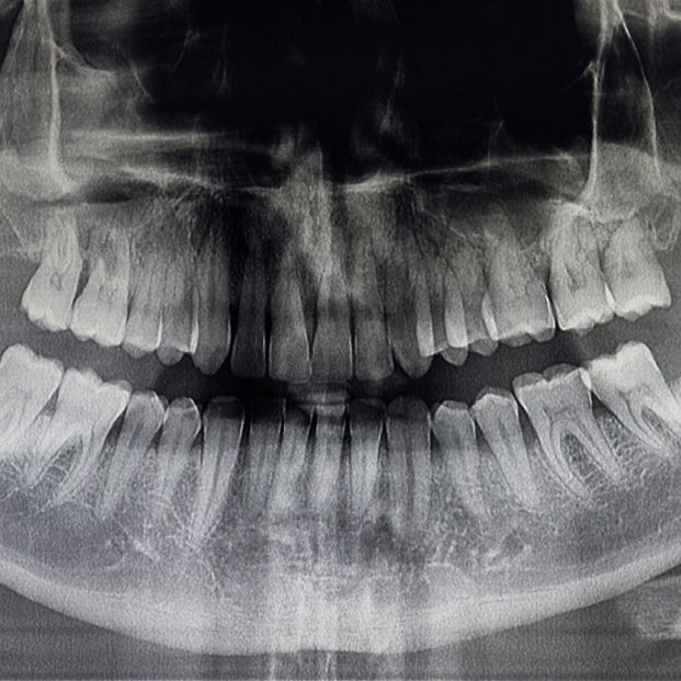 Qué hacer si se te desencaja la mandíbula: diagnóstico y tratamiento