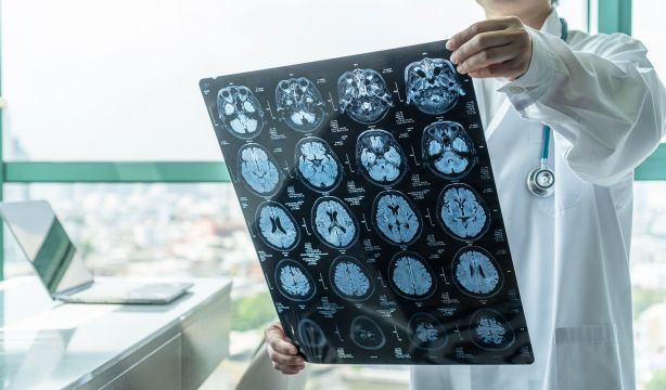 El 12 de Octubre busca pacientes con demencia con cuerpos de Lewy para avanzar en su diagnóstico