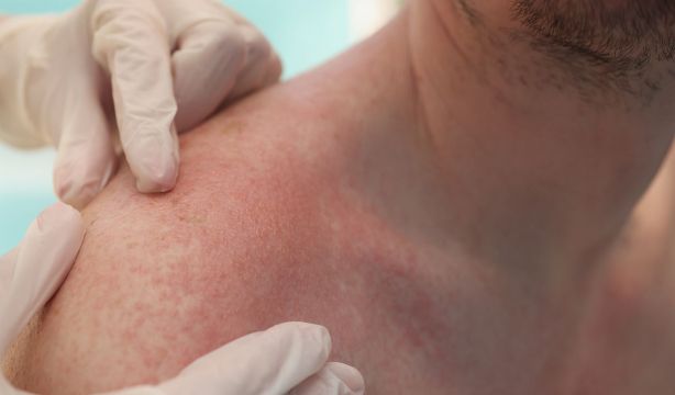 El envejecimiento de la población y la poca concienciación aumenta los casos de queratosis actínica