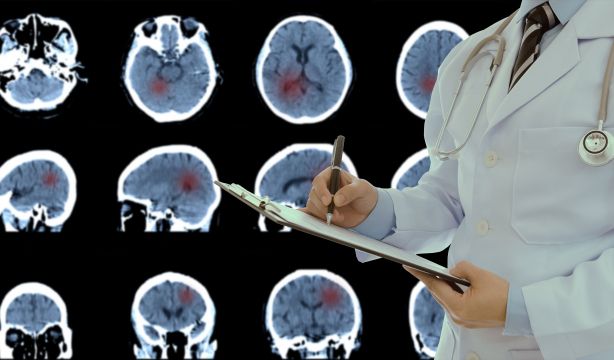 Golpe al tumor cerebral: en marcha una vacuna que aumenta la supervivencia