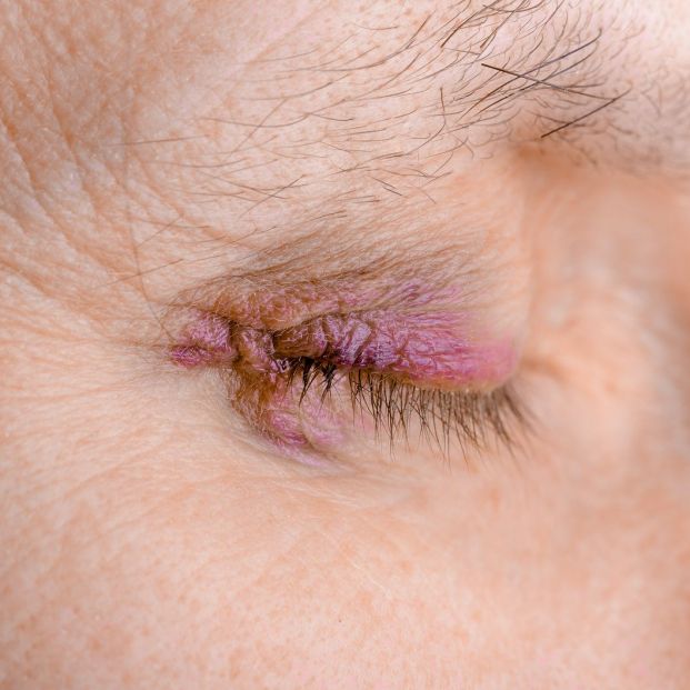 Remedios caseros para eliminar los cardenales Remedios caseros para eliminar los cardenales