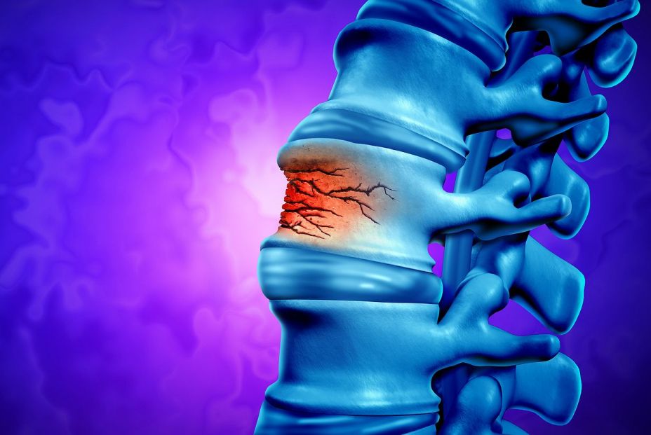 La grasa del brazo puede revelar el riesgo de sufrir fracturas de columna en mayores de 50 años