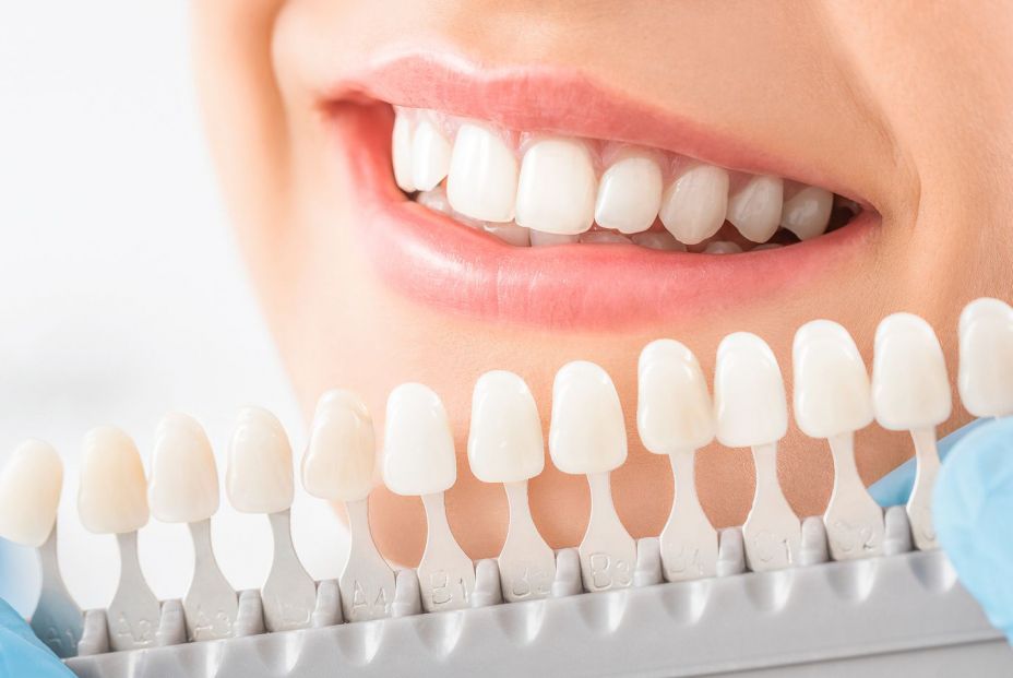 ¿En qué consiste un tratamiento de blanqueamiento dental? ¿En qué consiste un tratamiento de blanqueamiento dental?