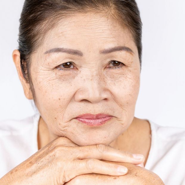 ¿Se pueden eliminar las pecas? ¿Se pueden eliminar las pecas?