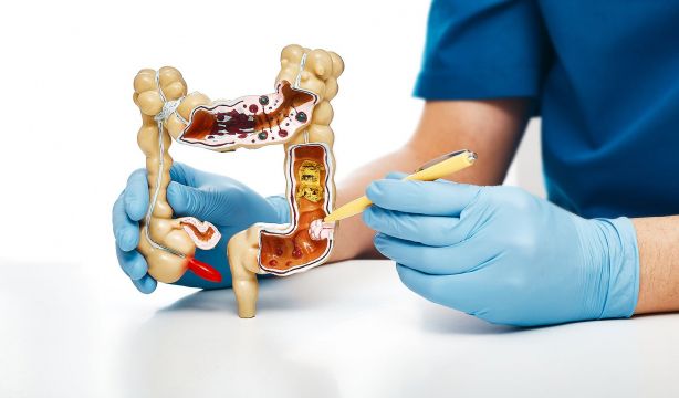 Esperanza contra el cáncer colorrectal: descubren una proteína clave para la metástasis