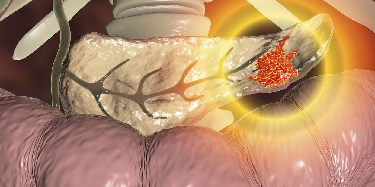  Un estudio muestra "resultados prometedores" en una terapia para el cáncer de páncreas (Big Stock)