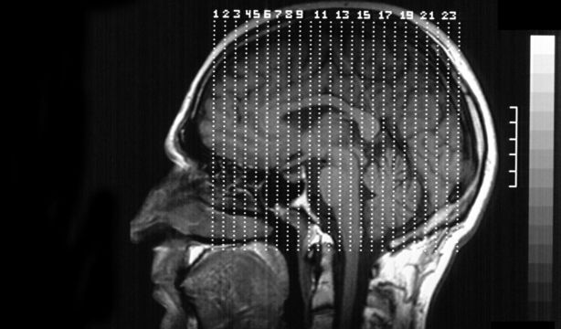 La ciencia descifra el mapa que puede ayudar a detectar de manera precoz el párkinson y el alzhéimer