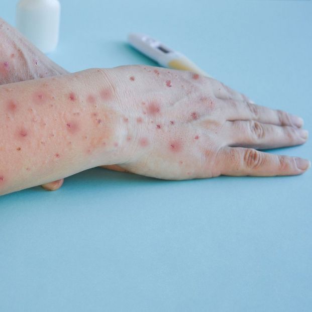 Crisis por la viruela del mono: casos en España, quién debe vacunarse y medidas por la nueva cepa