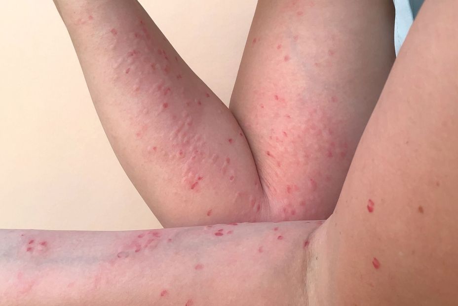 Expertos tranquilizan a los mayores por la viruela del mono: "No son una población en riesgo" Expertos tranquilizan a los mayores por la viruela del mono: "No son una población en riesgo"