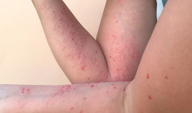 Expertos tranquilizan a los mayores por la viruela del mono: "No son una población en riesgo"