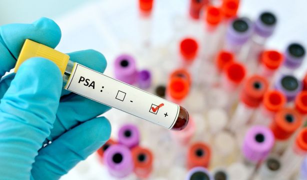 ¿Está sobrediagnosticado el cáncer de próstata?