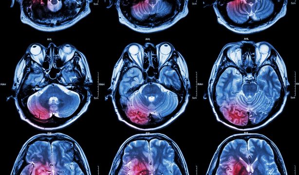Un antidepresivo se muestra prometedor para el tratamiento de tumores cerebrales
