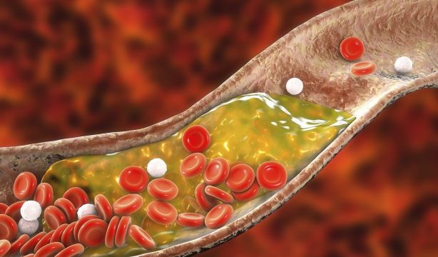 Estos son los 4 factores de riesgo que causan casi todos los infartos y accidentes cerebrovasculares