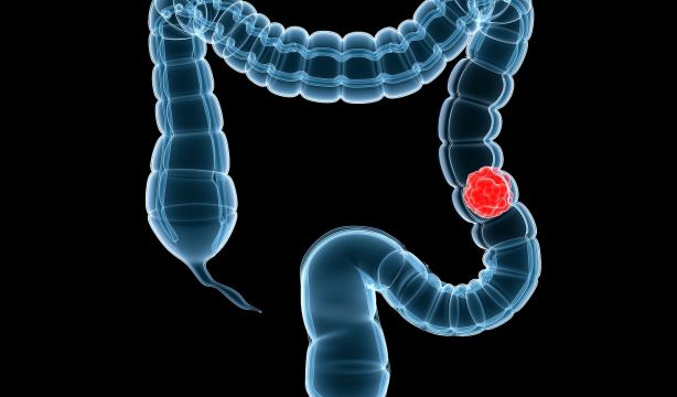 Este es el impacto del estrés crónico en el cáncer colorrectal