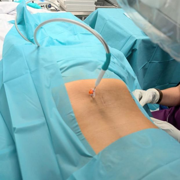 Radiofrecuencia basivertebral Radiofrecuencia basivertebral