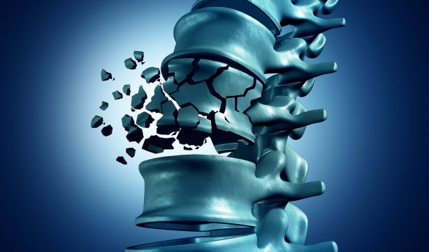 ¿Sabías que la mayoría de las fracturas vertebrales no muestran síntomas? Descubre por qué