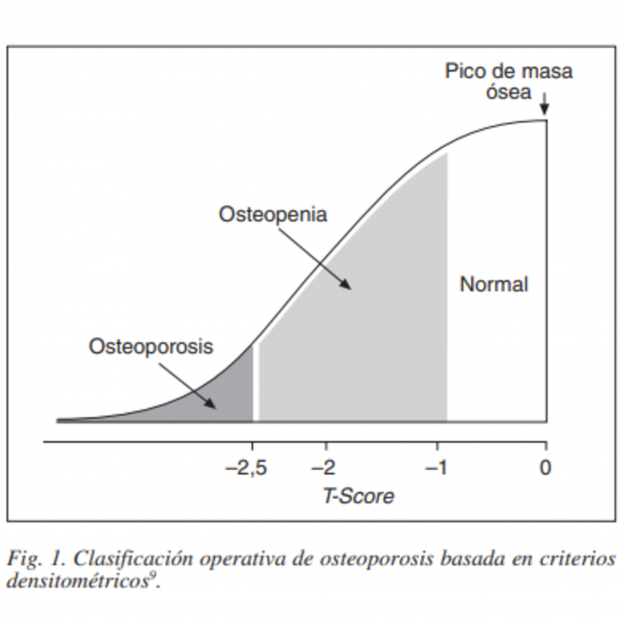 Gráfico explicativo de la osteopenia y la osteoporosis basado en la densidad ósea. Fuente: Sociedad Española de Endocrinología y Nutrición (SEEN) Gráfico explicativo de la osteopenia y la osteoporosis basado en la densidad ósea. Fuente: Sociedad Española de Endocrinología y Nutrición (SEEN)
