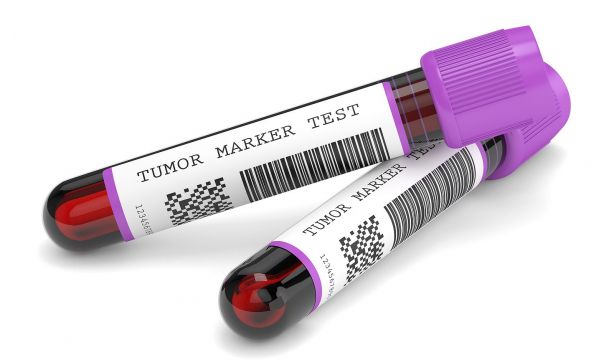 Desarrollan un dispositivo portátil que detecta el cáncer en una hora. Bigstock