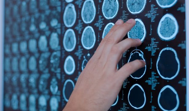 Uno de cada seis tumores se asocia a una posible infección