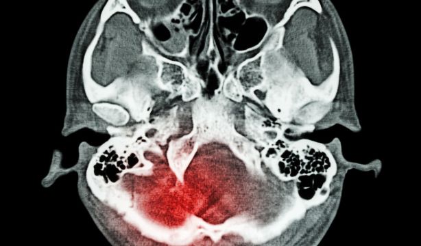Factores de riesgo relacionados con sufrir un ictus grave