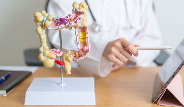 Nueva guía de EEUU para la colitis ulcerosa moderada o grave