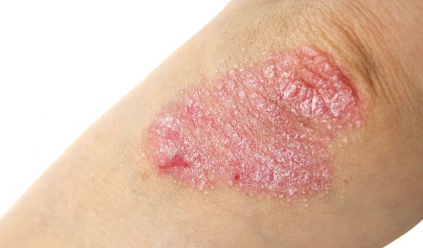 Si padeces psoriasis, estos son los alimentos que te perjudican (y mucho)