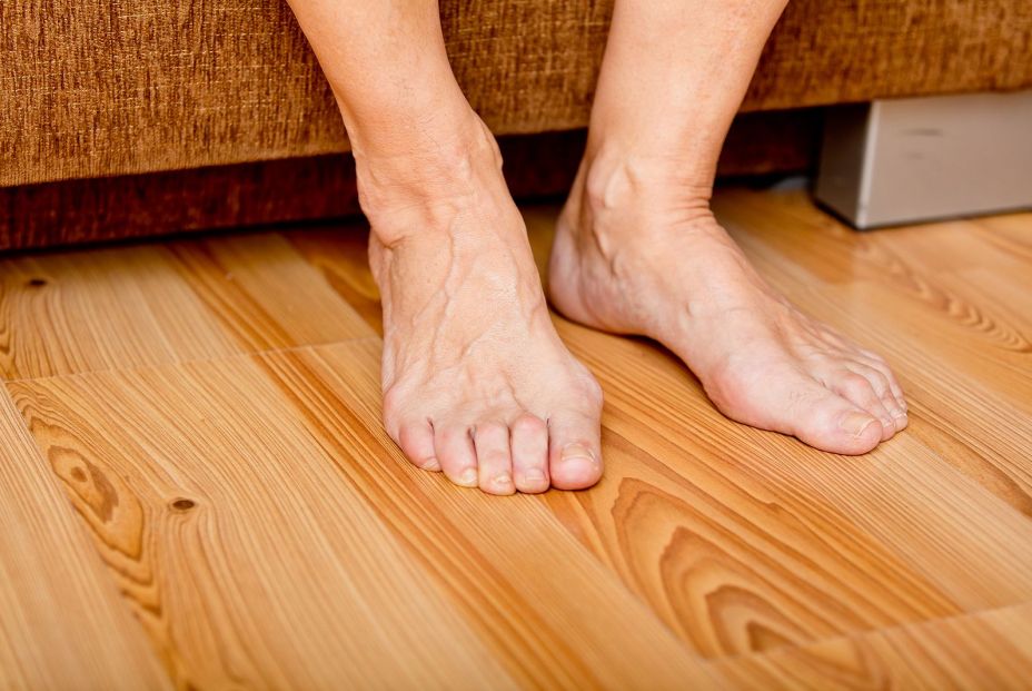 Fascitis plantar: ¿qué ejercicios puedo hacer para mejorar esta dolencia?