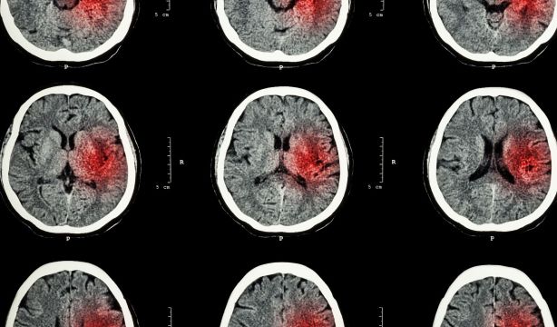 La rehabilitación robótica tras un ictus es beneficiosa