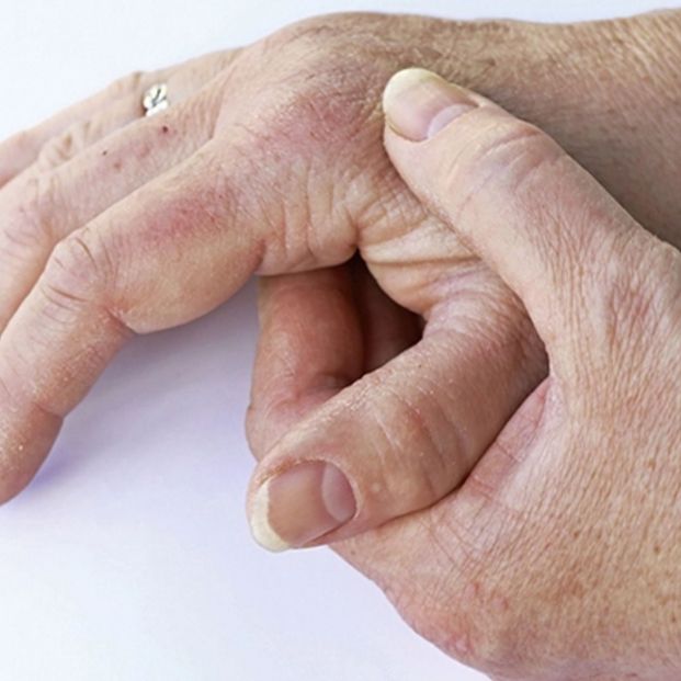 Manos con sabañones. Fuente: Colegio Oficial de Farmacéuticos de Madrid