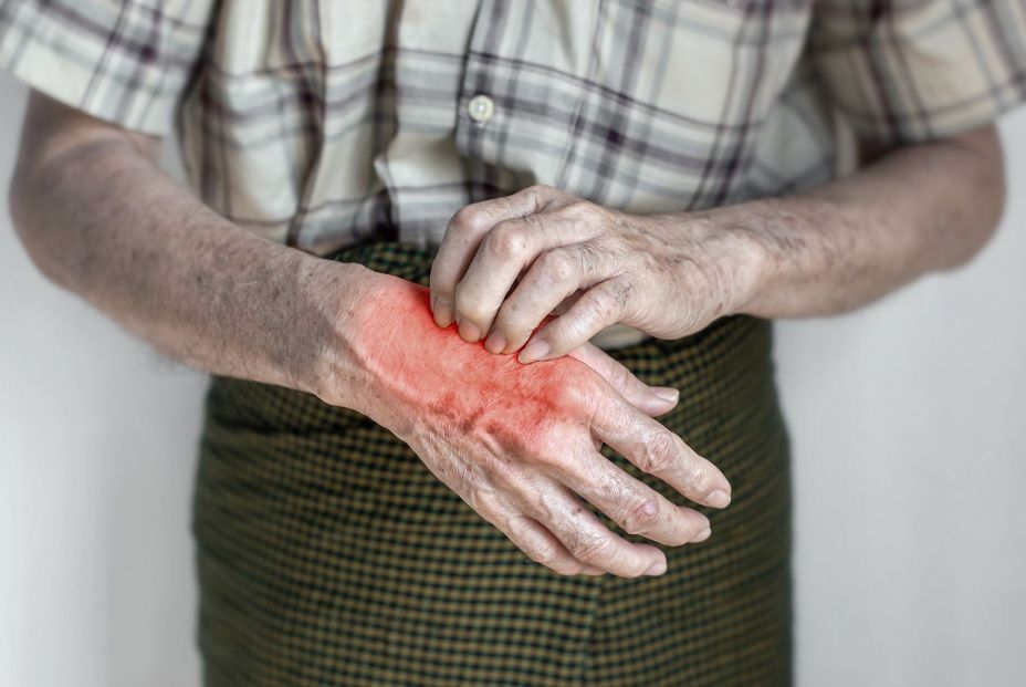 Detectan un brote de sarna en una residencia de mayores gallega que afecta a cerca de 20 personas