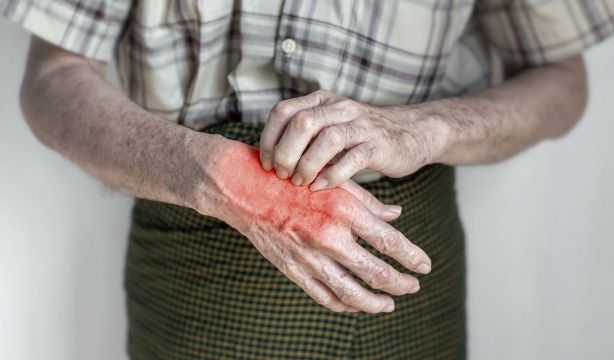 Detectan un brote de sarna en una residencia de mayores gallega que afecta a cerca de 20 personas