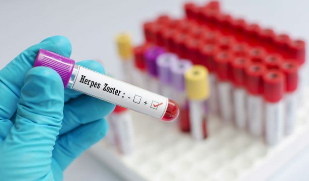 Un estudio relaciona el herpes zóster con un mayor riesgo de alzhéimer