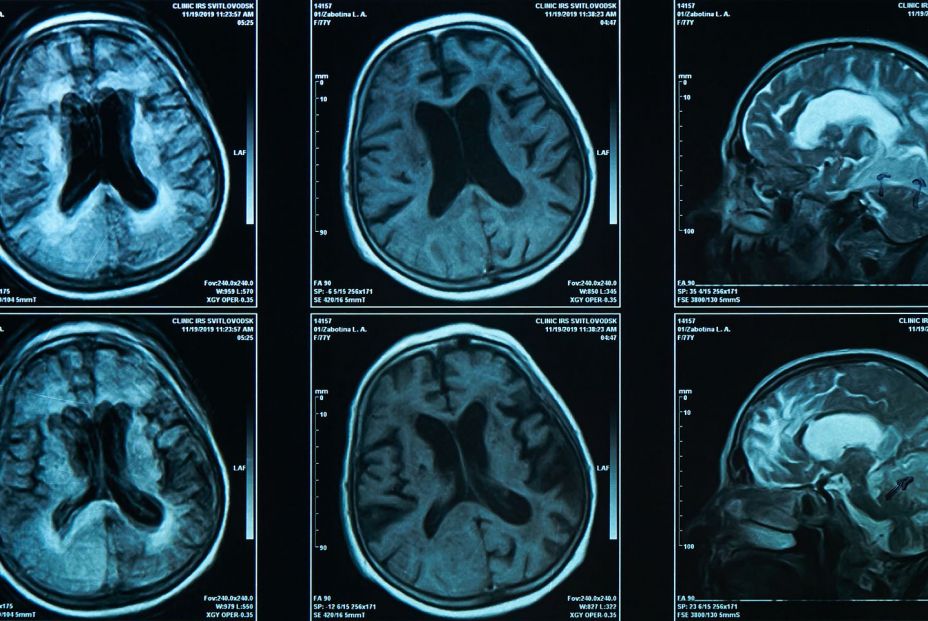 Imagen cerebral de una persona mayor. Bigstock 