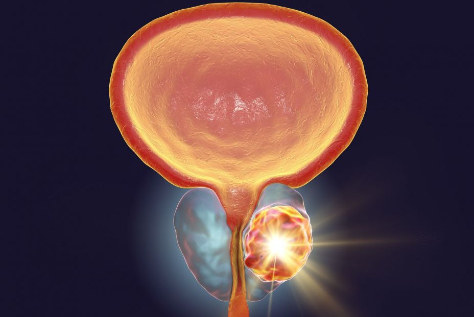 Cáncer de próstata y prostatitis: ¿en qué se diferencian?