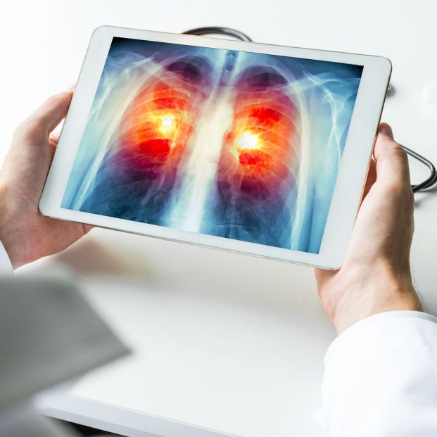 Posibles causas del cáncer de pulmón en no fumadores Posibles causas del cáncer de pulmón en no fumadores