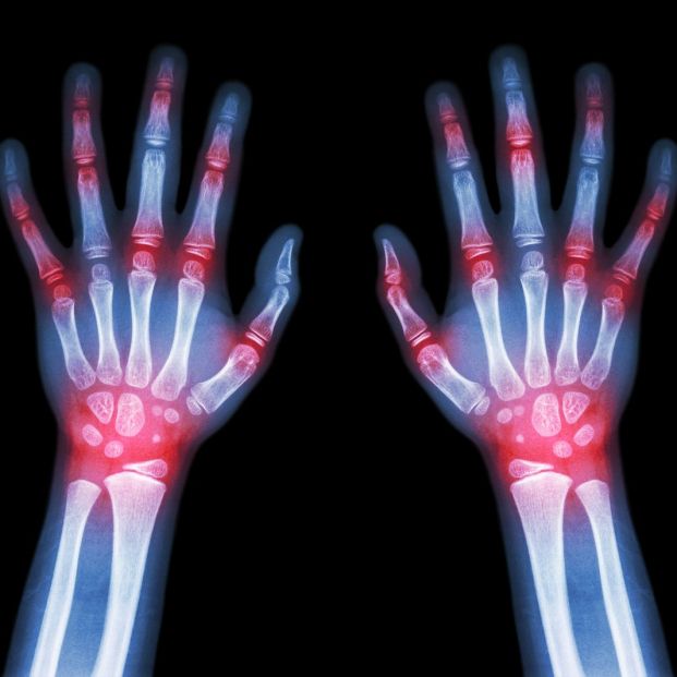bigstock Rheumatoid ArthritisGout Ar 103755428