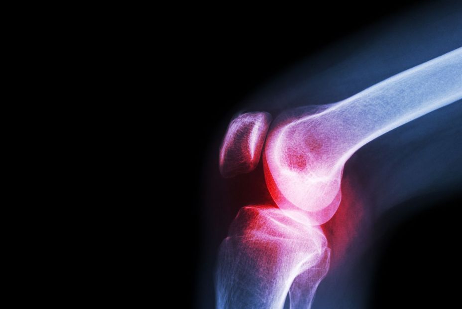 Imagen de Rayos X de artritis de rodilla. Bigstock 