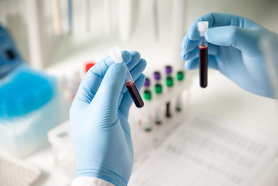 Un nuevo análisis de sangre de alta precisión para detectar el alzhéimer de forma precoz. Bigstock