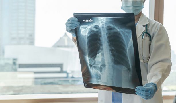 Avances contra el cáncer de pulmón: identifican una proteína como diana terapéutica