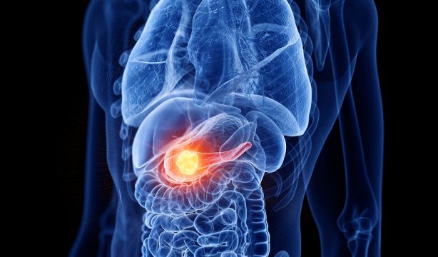 Nueva estrategia contra el cáncer de páncreas: radioterapia y calor inducido por nanopartículas